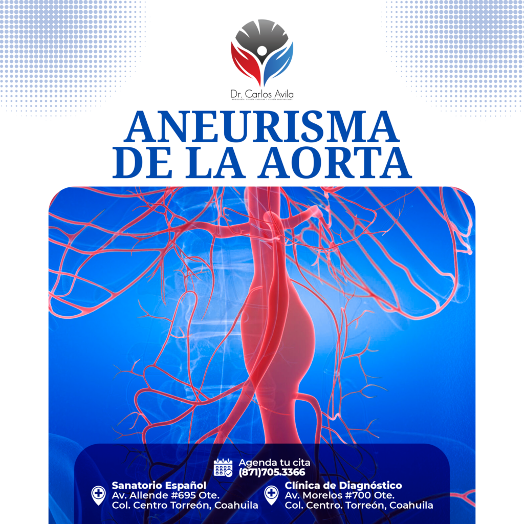 4 aneurisma aorta