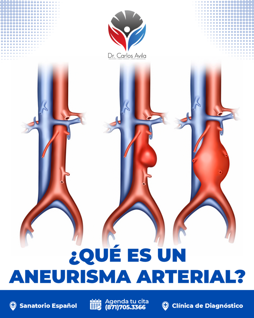 7 qué es un aneurisma arterial