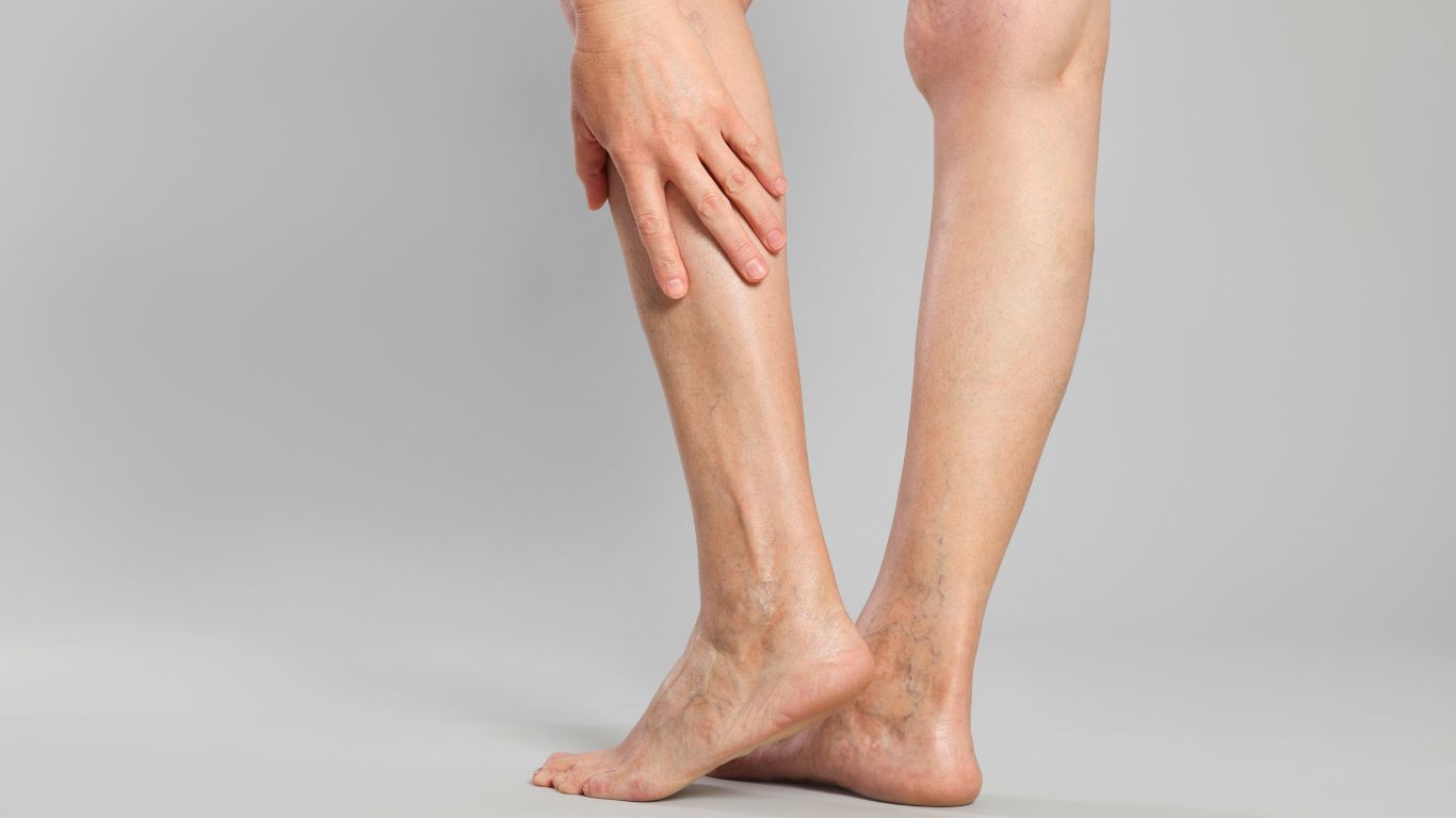 todo sobre las varices causas sintomas y tratamientos clinica premium