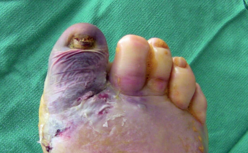 figure 1 diabetic blister