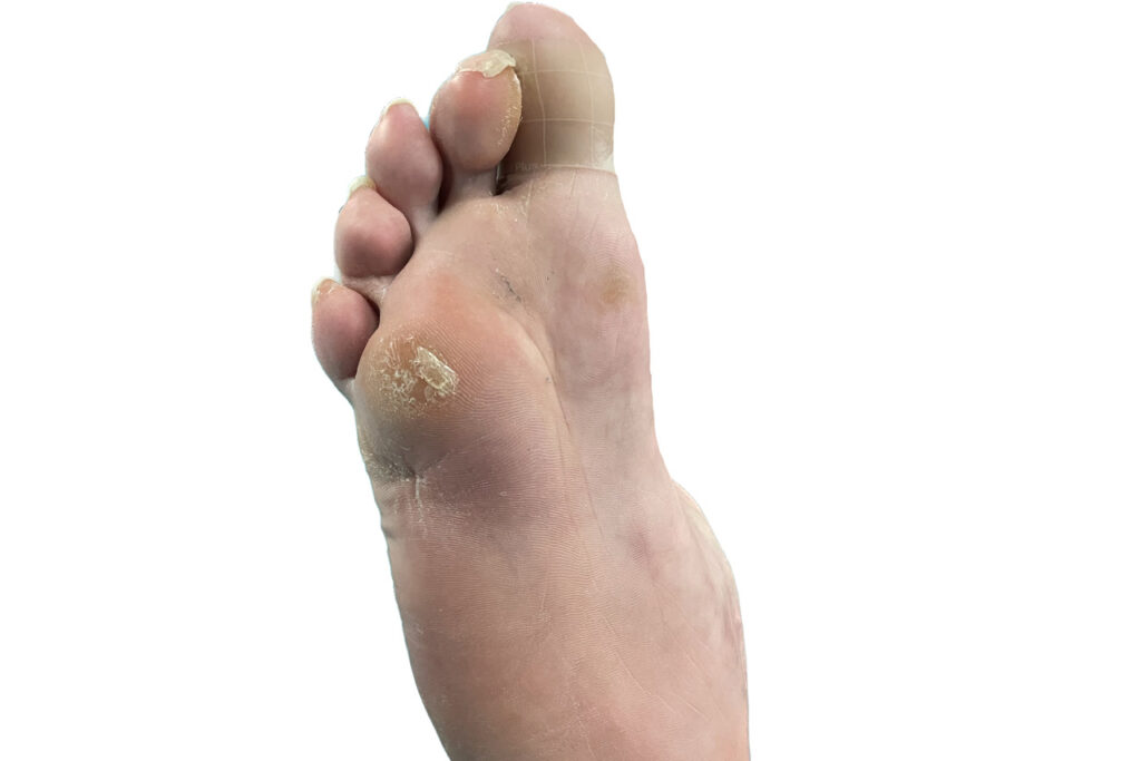piediabetico 2